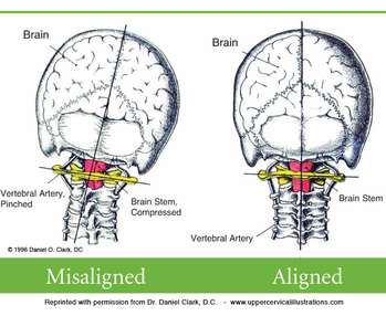 Occipital Neuralgia | Occipital Headache | Doctors | Specialists