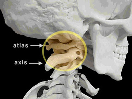 What Are The Signs And Symptoms Of Atlas Subluxation Complex Asc Upper Cervical Health Centers Boise 8 559 0541