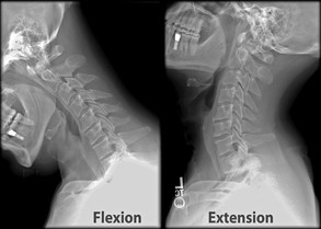 flexion extension cervical spine x-rays